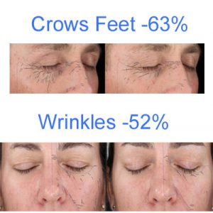 crows-feet
